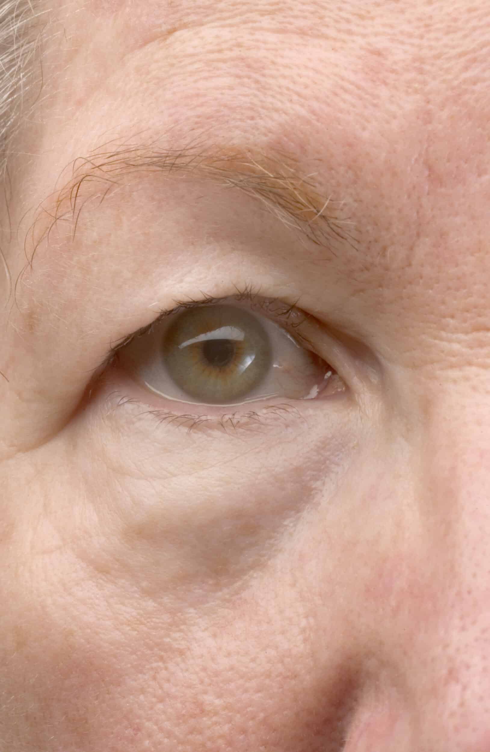 Woman's droopy eyelid